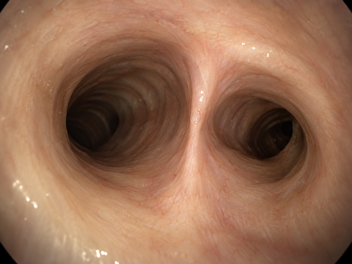AI-generated illustration of the windpipe dividing into the two main airways, as viewed during bronchoscopy.